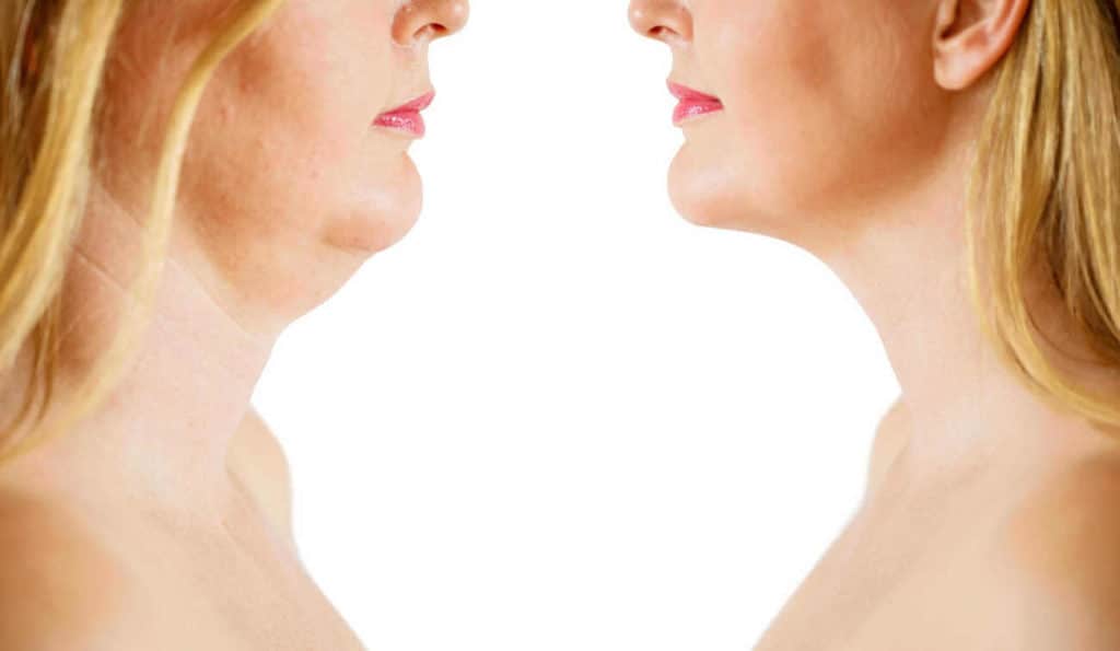 Double Chin treatment Enfield Highway before and after results