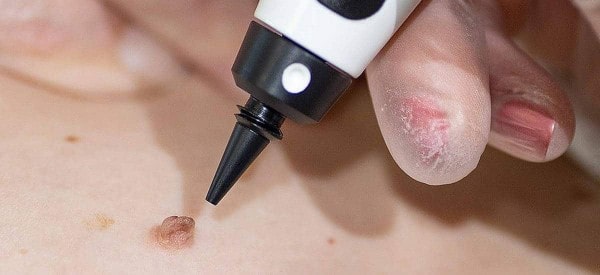 After Skin Tag Removal Enfield Highway