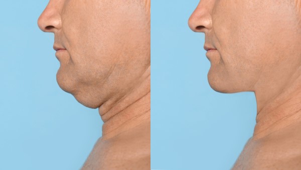 Which Non-Surgical Treatments Work Best for Jowls and Loose Skin Enfield Highway?