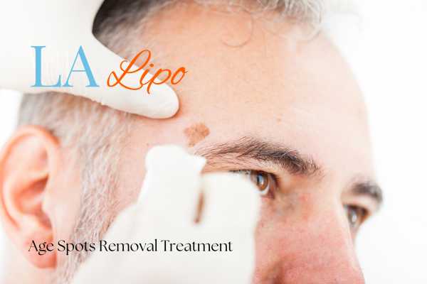 What Are the Most Effective Treatments for Age Spots Enfield Highway?