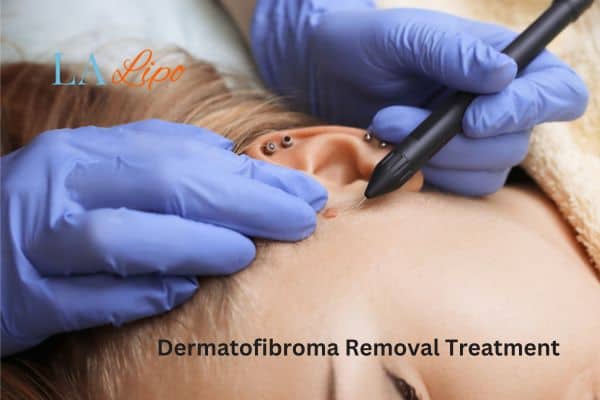 Dermatofibroma Removal Treatment Enfield Highway