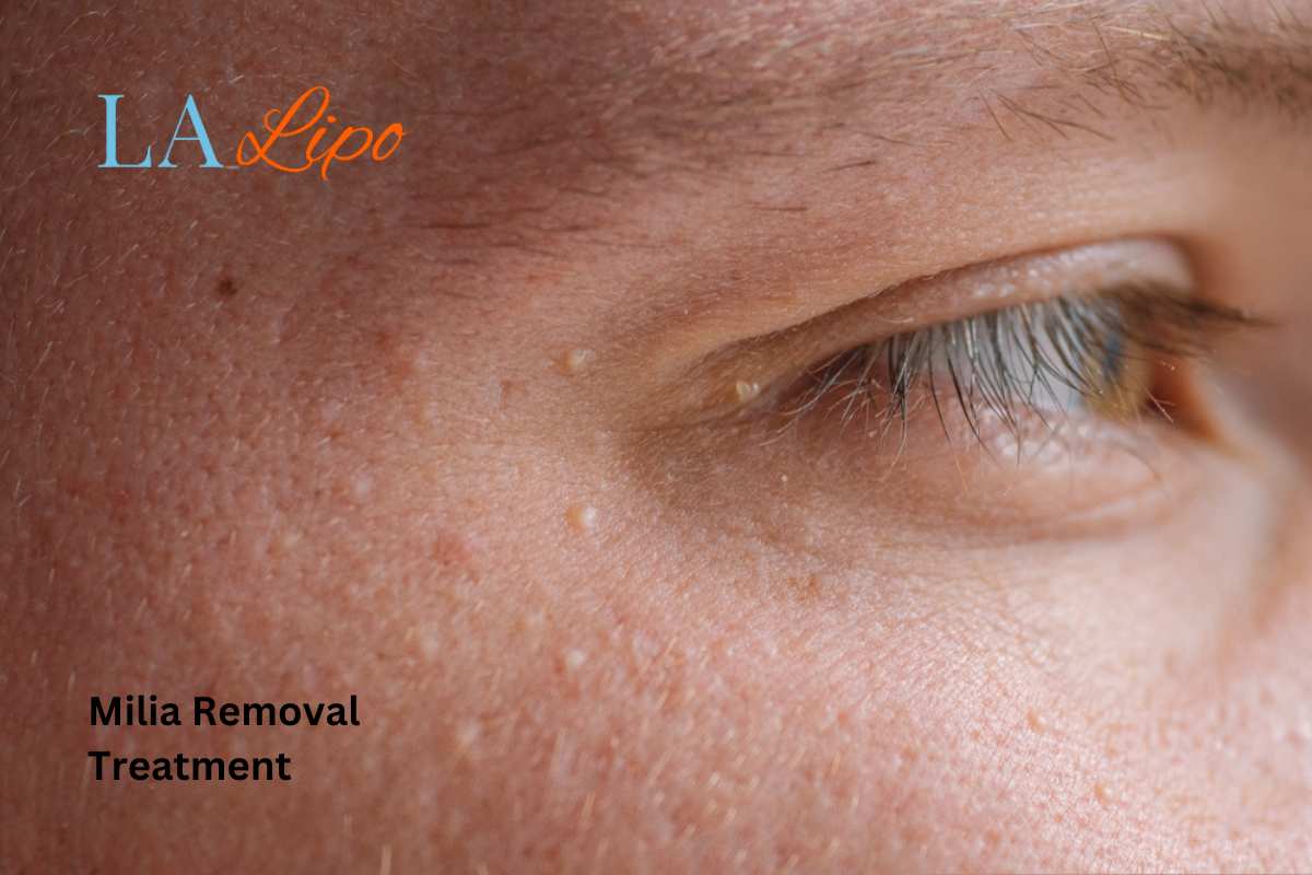 Cryopen Milia Removal: Is It the Easiest and Safest Option Enfield Highway?