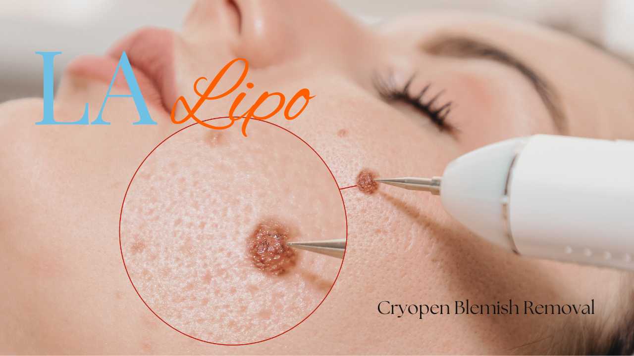 cryopen blemish removal Enfield Highway Contact our team today!