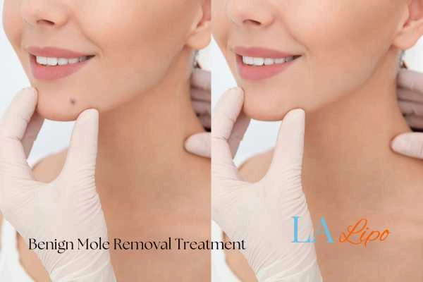 woman's before and after mole removal Enfield Highway results