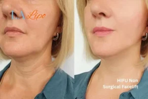hi-fu for wrinkles Enfield Highway before and after results