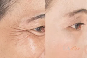 Before and after results of woman - HI-fu wrinkles reduction treatment Enfield Highway