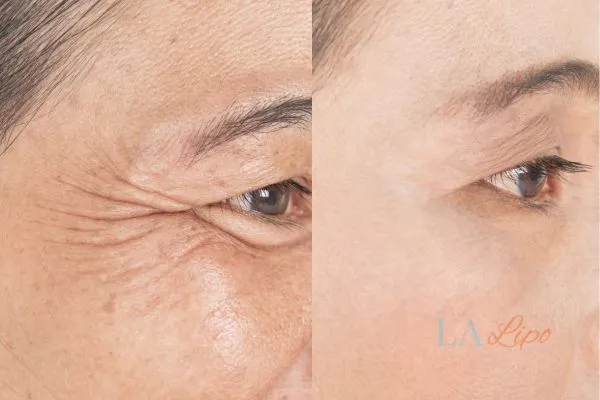 Before and after results of woman - HI-fu wrinkles reduction treatment Enfield Highway