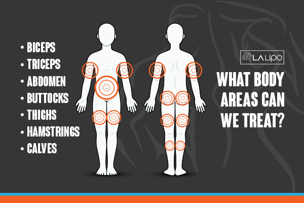 Graphic to show areas you can have LA-EMS Body Sculpting Enfield Highway treatment.