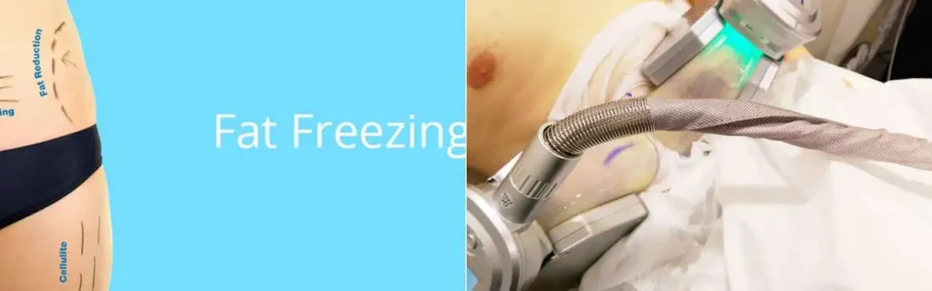 Fat freezing Enfield Highway on multiple areas of the body