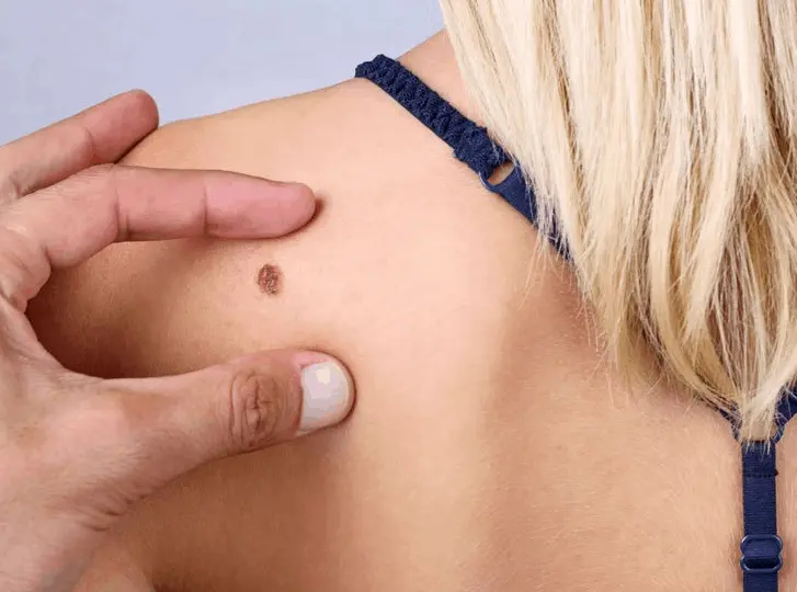 woman having mole removal Enfield Highway consultation before treatment.