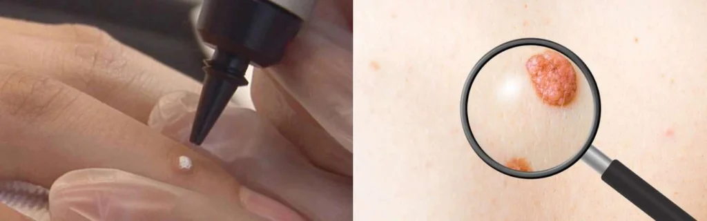 CryoPen practitioner Enfield Highway assessing a benign mole before treatment