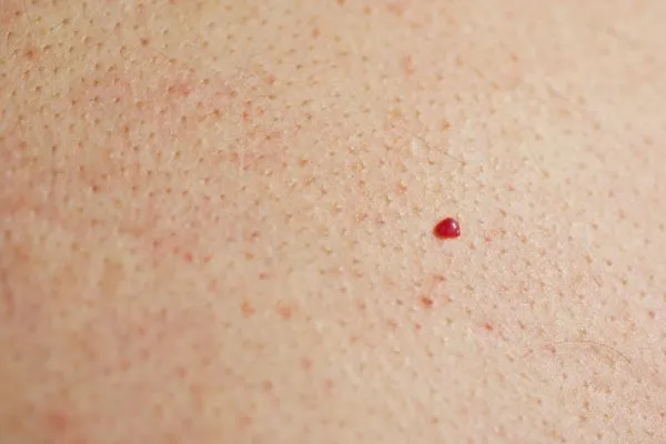 close up of a cherry angioma Enfield Highway