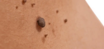 image of a skin tag Enfield Highway