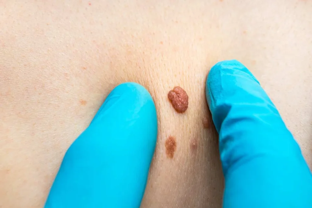 Consultant examining a skin tag Enfield Highway