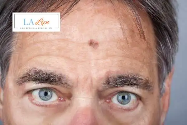 Solar Lentigo Removal Enfield Highway image of man with mark on his forehead