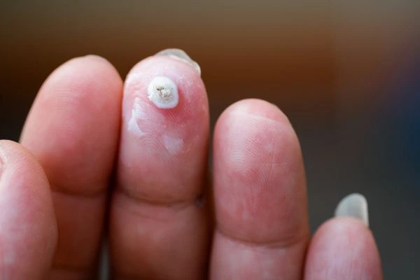 wart on person finger - cryotherapy to treat from LA LIPO Enfield Highway