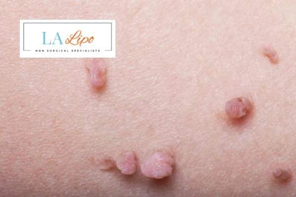 Does cryopen skin tag removal Enfield Highway hurt? Find out now call our team today!