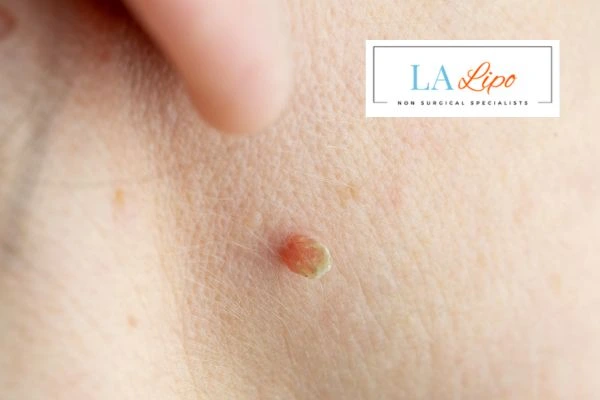 Book skin tag removal Enfield Highway today speak to our team now!