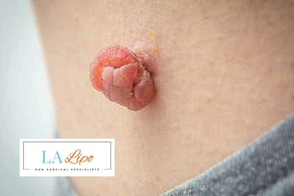 Interested in skin tag removal Enfield Highway? Concerned about the pain? Find out more today!