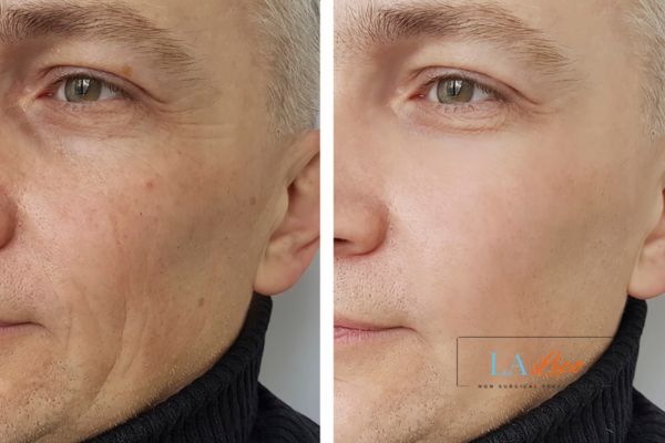 See the amazing results of Morpheus8 Treatment Enfield Highway!