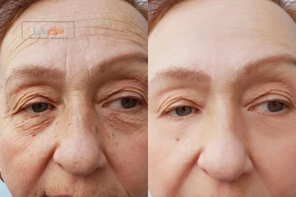 The powerful benefits of Morpheus8 Treatment Enfield Highway - Call Our team today!