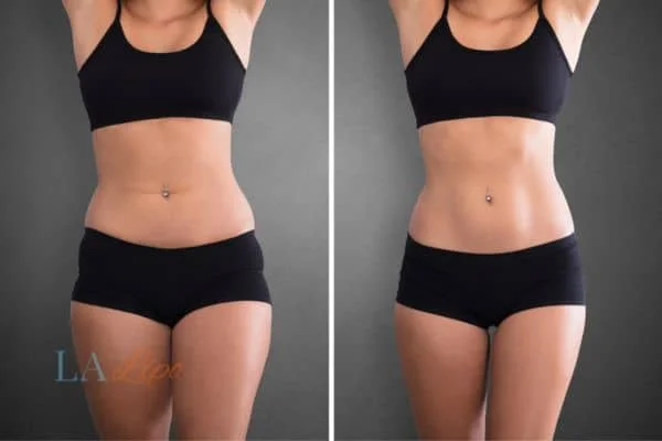 before and after results of non-surgical treatment to help a woman's body image and mental health Enfield Highway