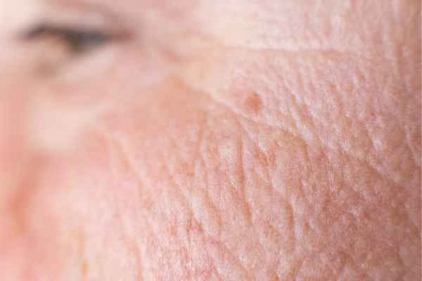 close up picture of a woman's face showing an age spot Enfield Highway