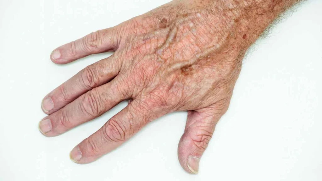 Male hand showing age spot Enfield Highway