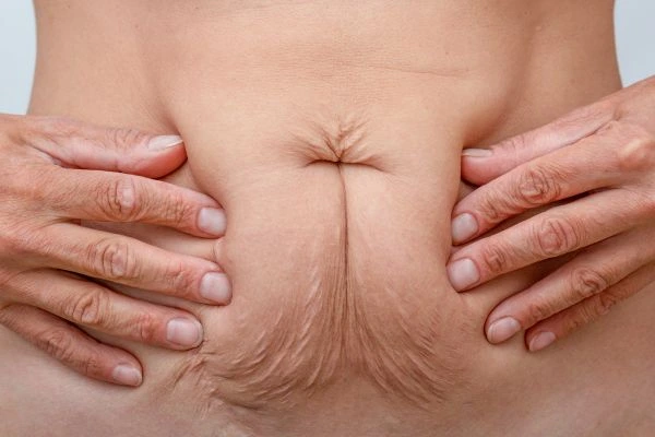 Image of a woman's stomach with loose skin - example of skin tightening Enfield Highway options