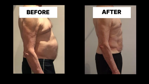 What Symptoms Can Diastasis Recti Cause in Men? Weak Core, Back Pain and Poor Posture Enfield Highway